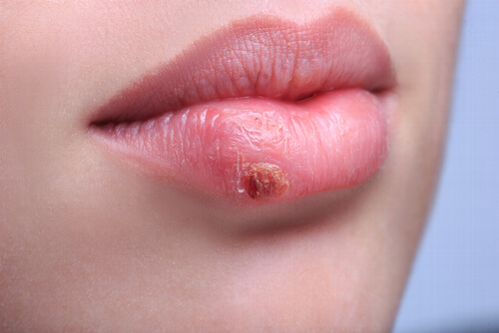 Imagen Advierten que herpes labial puede contagiarse a genitales