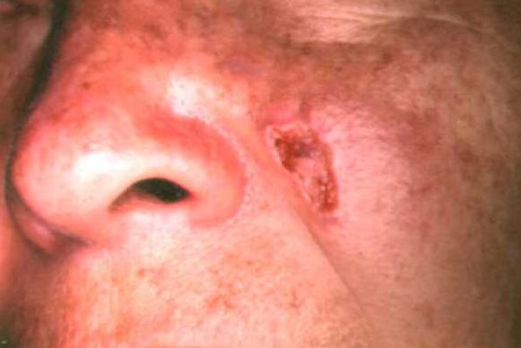 Imagen Melanoma, el cáncer de piel más agresivo: Especialista