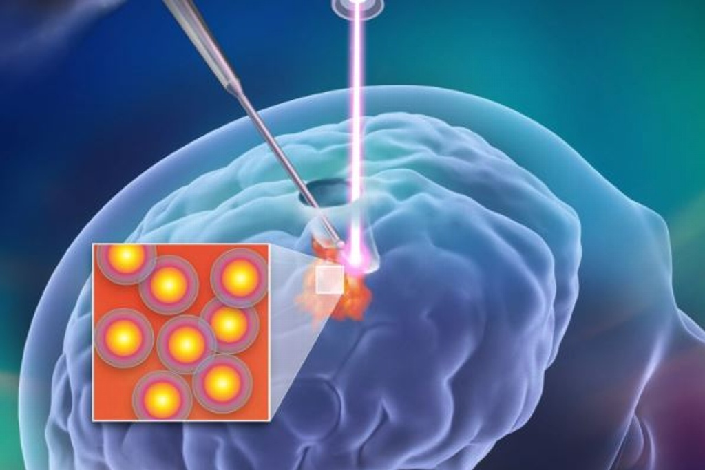 Imagen Tecnología láser ayuda a extirpar tumores cerebrales con mínima invasión