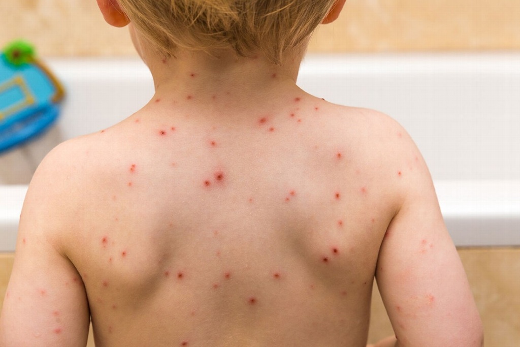 Imagen La varicela se presenta todo el año, pero repunta en Otoño-Invierno: Médico