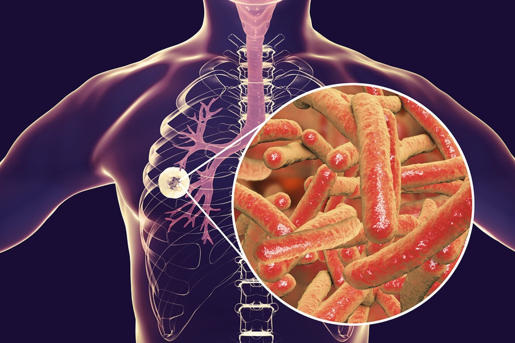 Imagen Exhortan a prevenir la tuberculosis; se contagia de una persona a otra