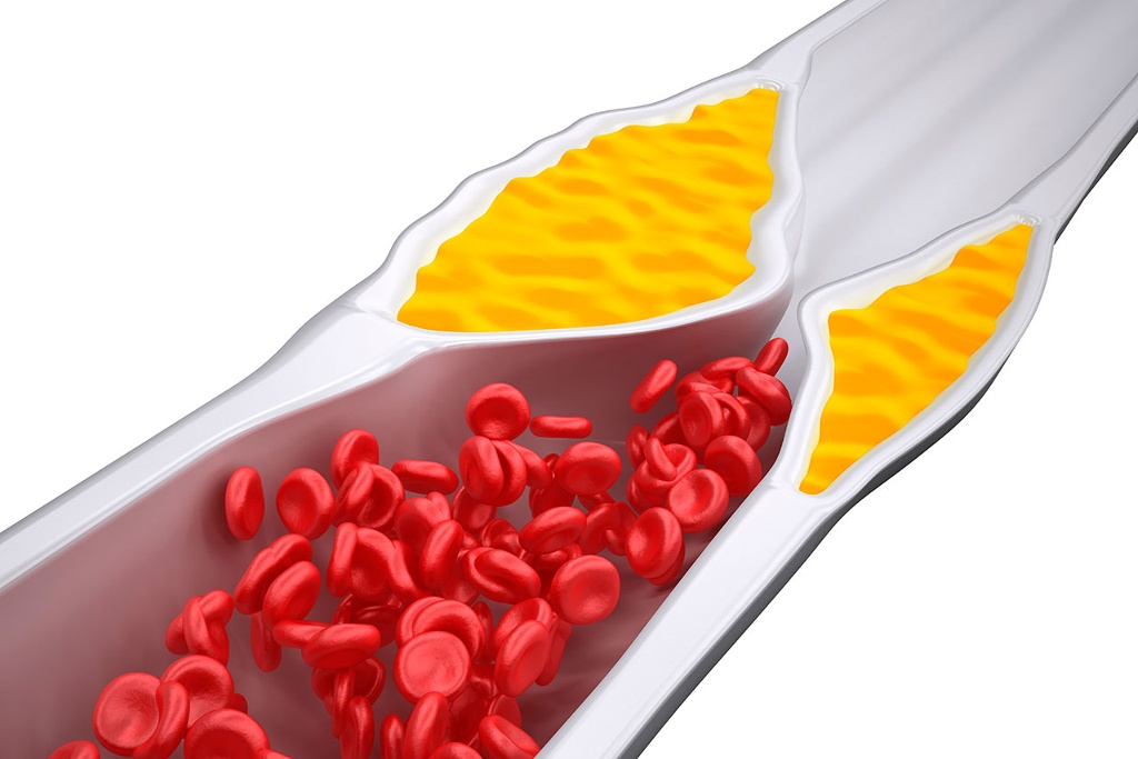 Imagen Médico recomienda cuidar los niveles de colesterol