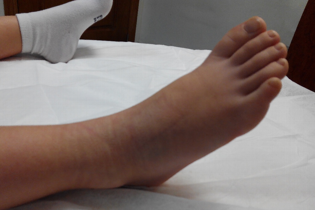 Imagen Insectos se incrustan en pie de una niña; médicos le diagnostican tungiasis