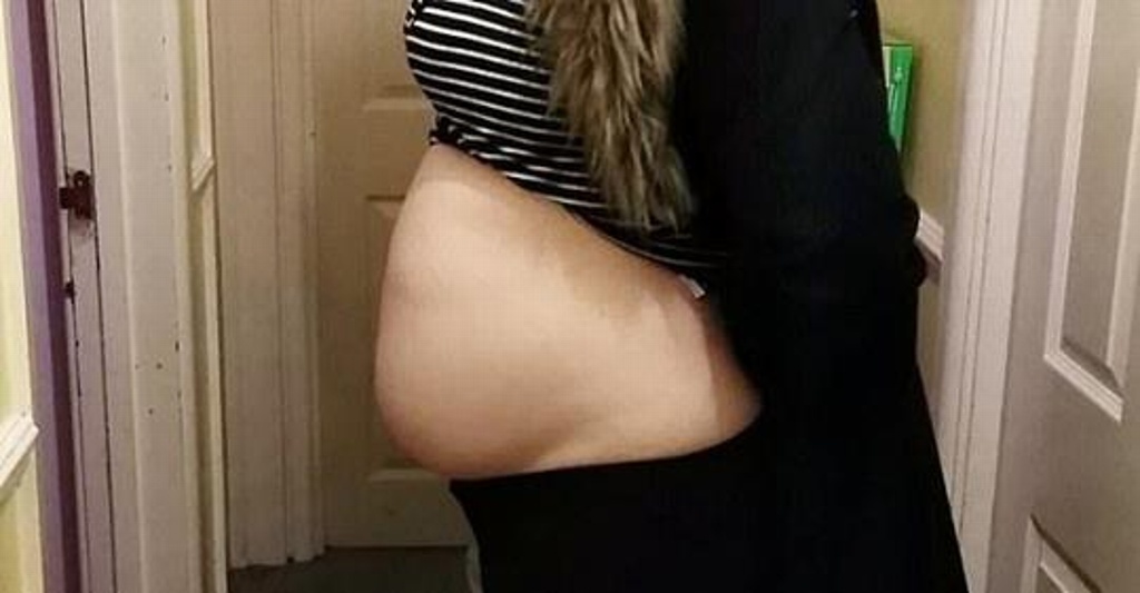 Imagen Creía estar embarazada; le quitan tumor de 4 kilos
