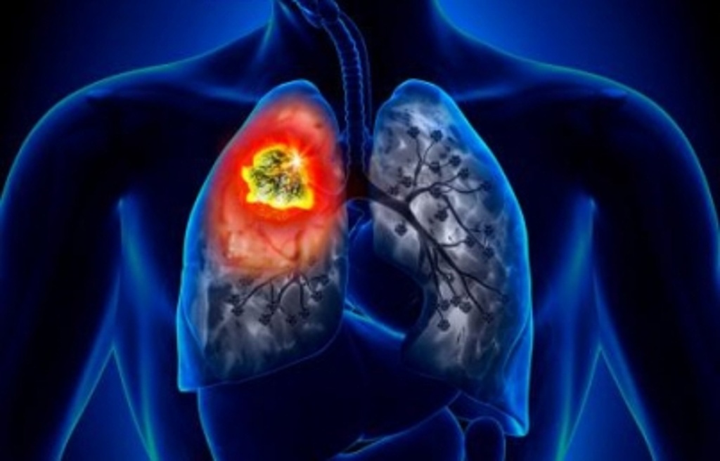 Imagen Atenderán a pacientes con cáncer de pulmón socialmente vulnerables