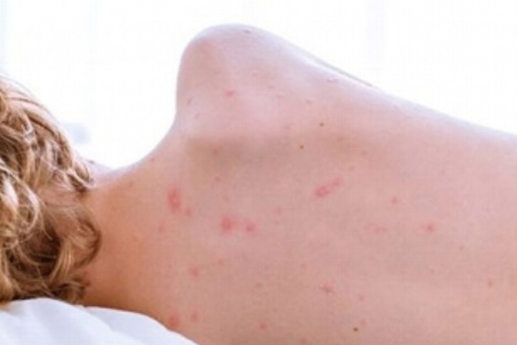 Imagen Desde enero se han triplicado los casos de sarampión, reporta OMS