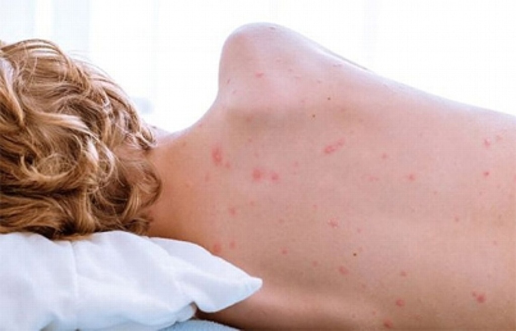 Imagen ¿Sabes qué es el sarampión y cómo prevenirlo?