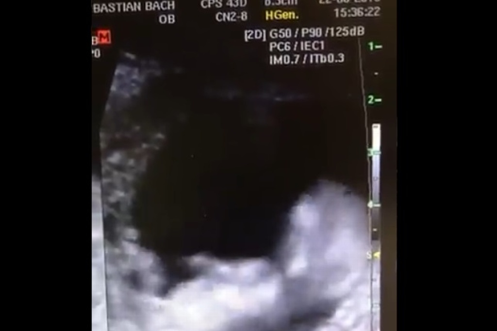 Imagen Se viraliza ultrasonido de bebé 