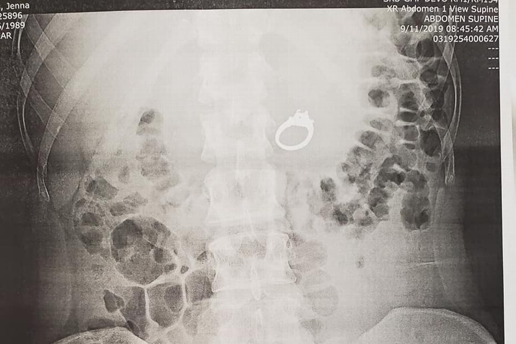 Imagen Por una pesadilla, mujer se traga su anillo de compromiso