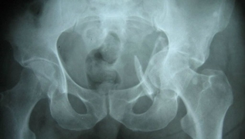 Imagen Dos millones de mexicanas padecen osteoporosis, señala experto
