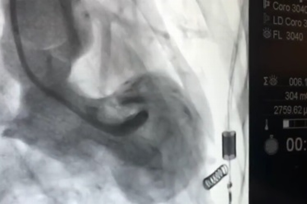 Imagen Impresionante, el “síndrome del corazón roto” que confunden con un franco infarto  (+Video)