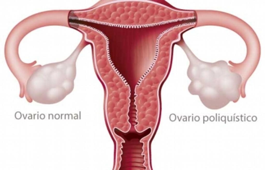 Imagen Sugieren vigilancia a mujeres con síndrome de ovario poliquístico