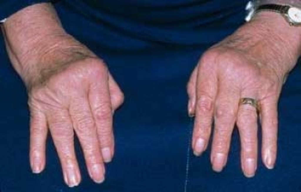 Imagen Analizan vínculos de artritis reumatoide con otras enfermedades