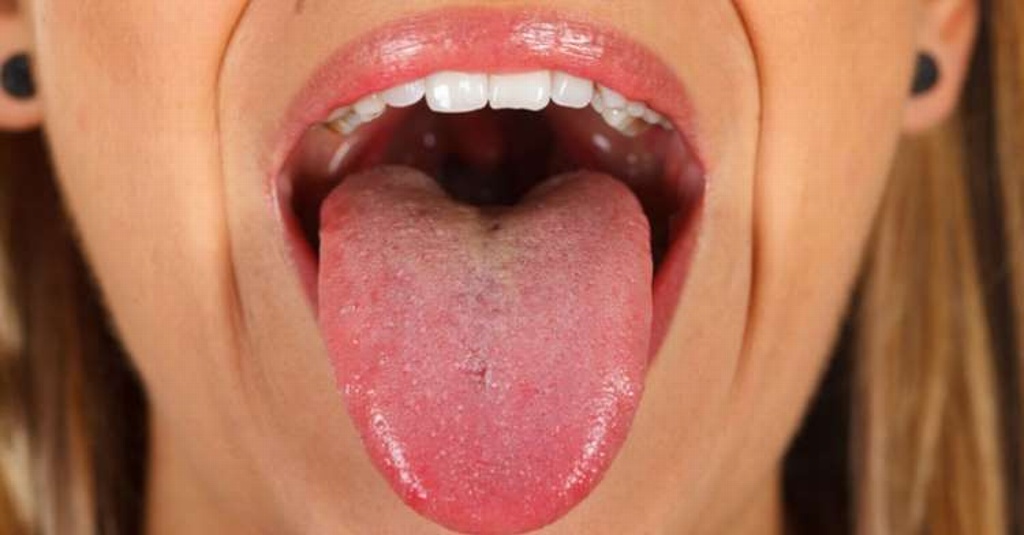 Imagen ¿Sabes qué enfermedad tienes según el aspecto de tu lengua?