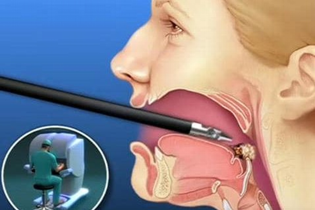 Imagen Hallan técnica para detectar cáncer de boca y garganta