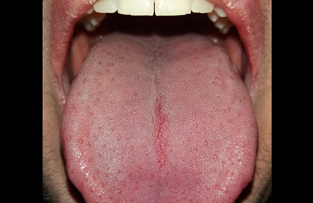 Imagen Puedes detectar si tienes Virus del Papiloma Humano con tu saliva