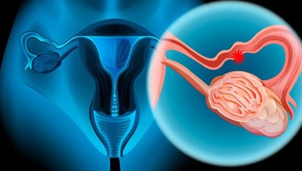 Imagen Estos son los síntomas de cáncer de ovario que las mujeres podrían estar ignorando
