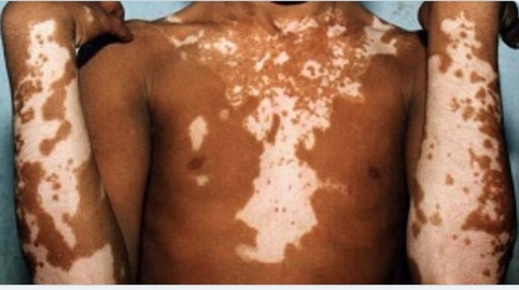 Imagen ¿Sabes qué es y cómo se produce el vitiligo?