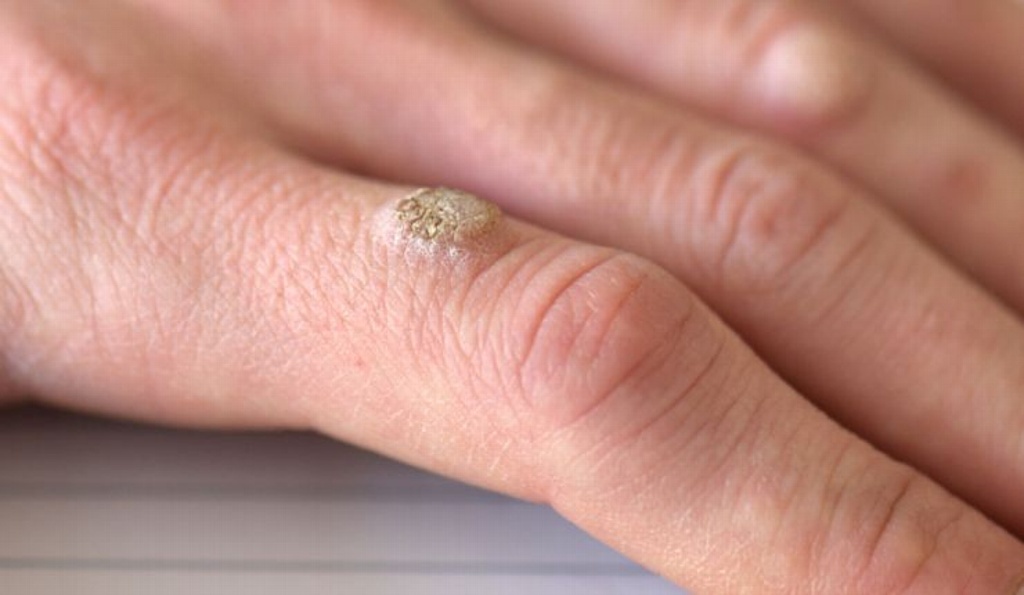 Imagen Advierten que VPH también se contagia a través de los dedos y las uñas