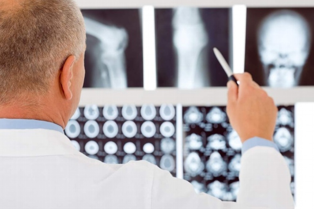 Imagen Esto es lo que debes saber acerca de la osteoporosis