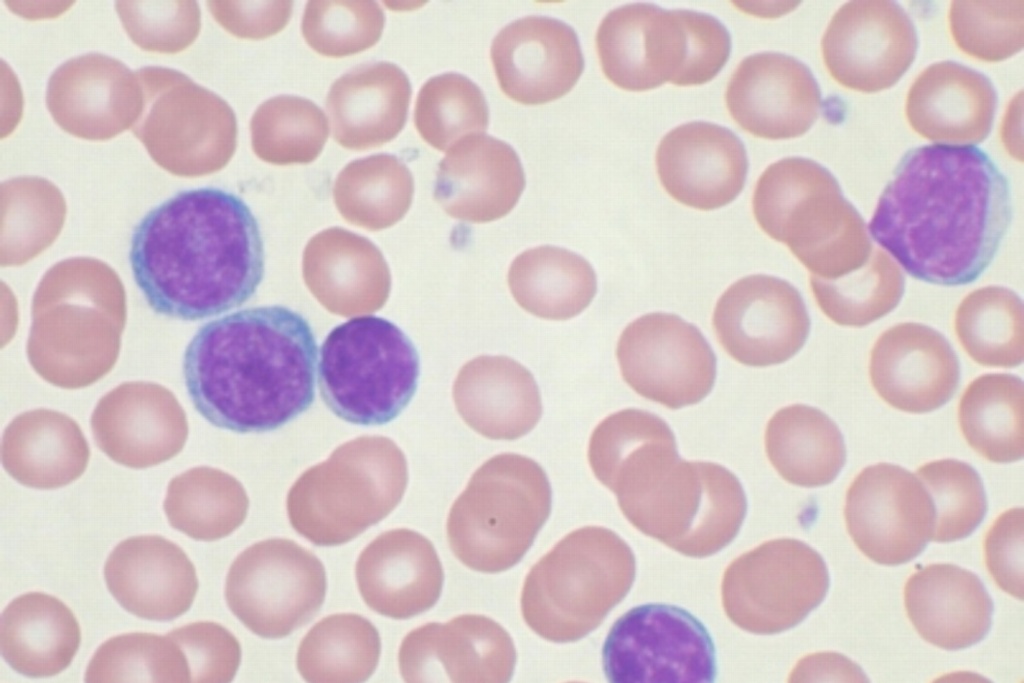Imagen La leucemia mieloide, enfermedad que afecta a cinco mil jóvenes al año