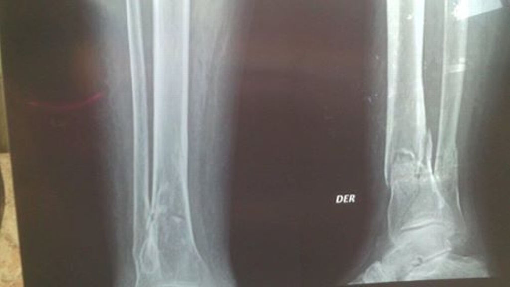 Imagen Se fracturó la pierna, tiene 73 años, padece epilepsia y no cuenta con recursos