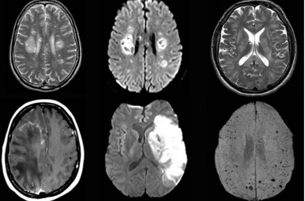 Imagen Inquieta a científicos inflamación cerebral en pacientes con COVID-19