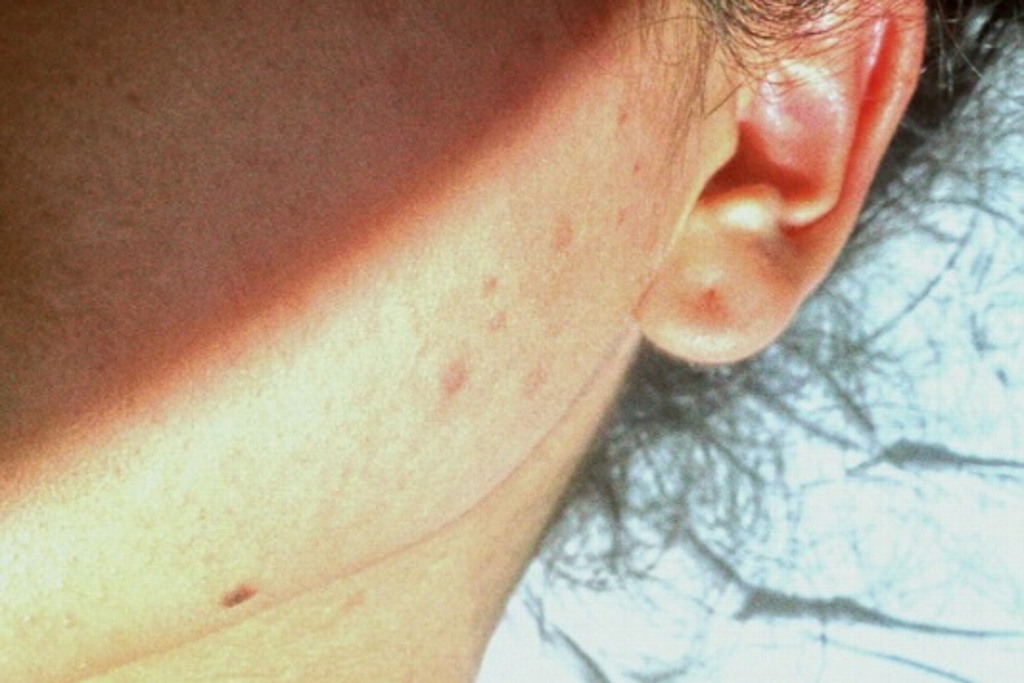 Imagen Uso de cubrebocas podría reactivar acné, aseguran especialistas 