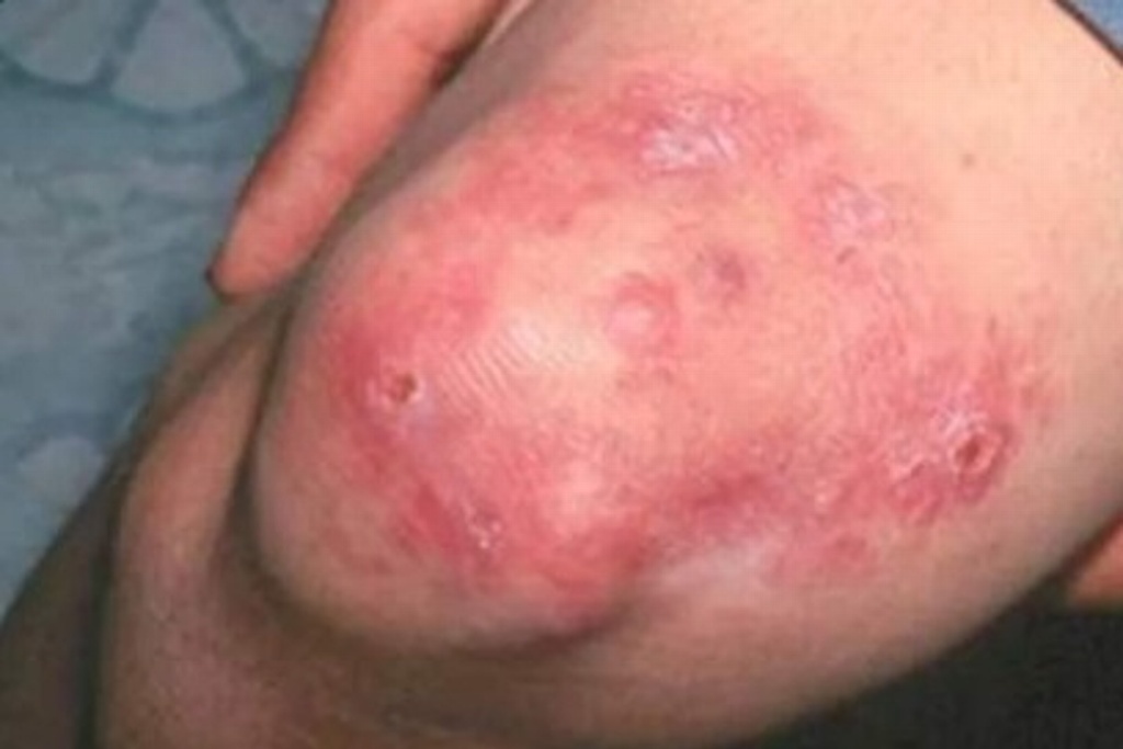 Imagen Reportan casos de lepra en 18 estados
