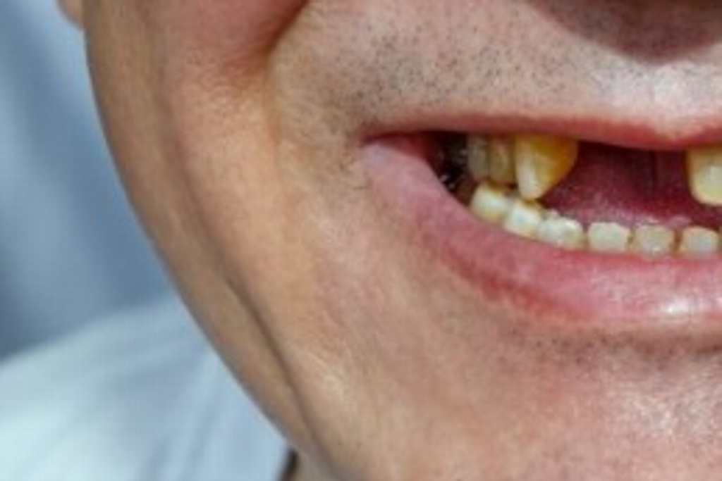 Imagen Caída de dientes, entre los nuevos efectos tras padecer de COVID-19