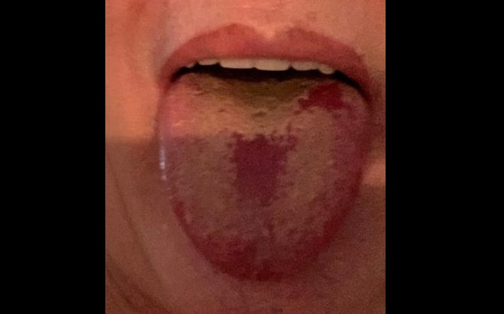 Imagen Advierten sobre la “lengua COVID”, un síntoma cada vez más común