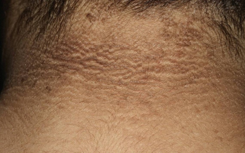 Imagen ¿Tienes el cuello oscuro? Chécate, podrías padecer diabetes 