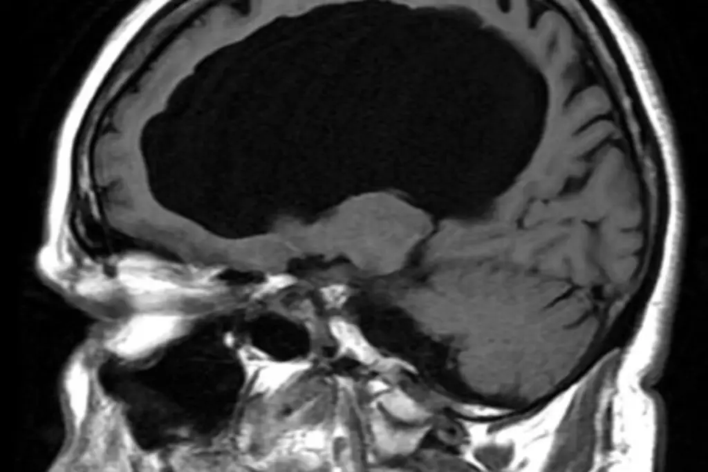 Imagen Un raro moho negro tóxico crece en su cerebro tras rasparse el codo