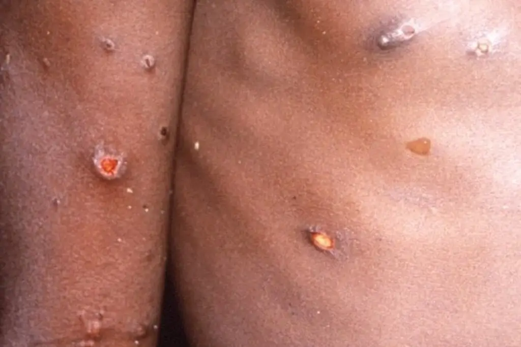 Imagen Así puedes evitar las cicatrices de la viruela del mono