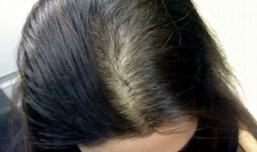 Imagen ¿Qué es la alopecia y qué provoca la enfermedad?