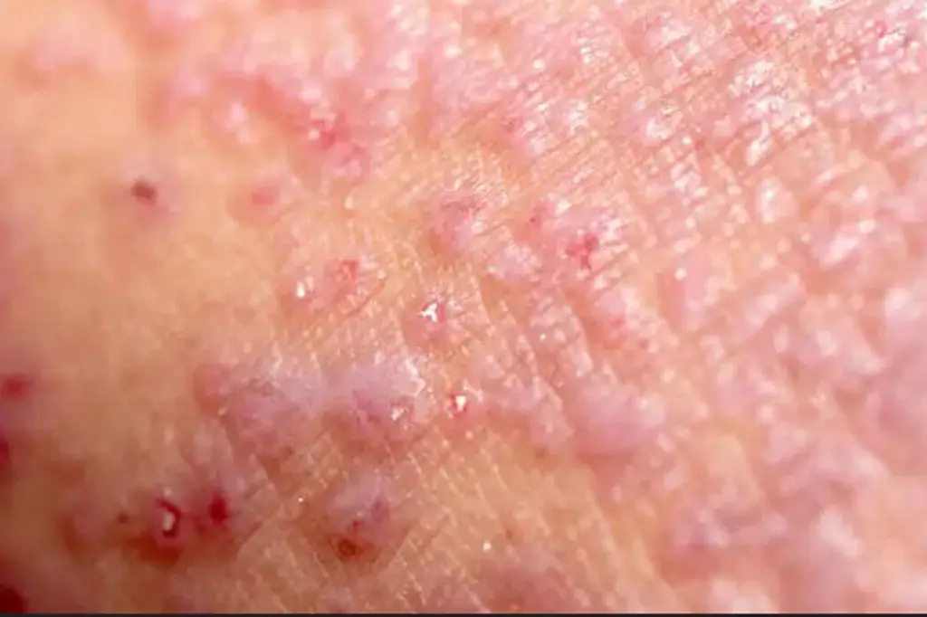 Imagen Reportan posible caso de viruela del mono en el puerto de Veracruz y otro en Xalapa