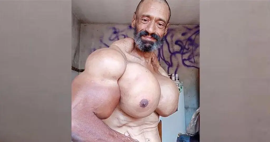 Imagen Muere fisicoculturista el 'Hulk' tras inyectarse aceite 