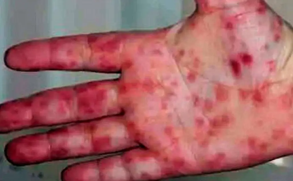 Imagen ¿Qué es la gripe del tomate?  Esto explica médico