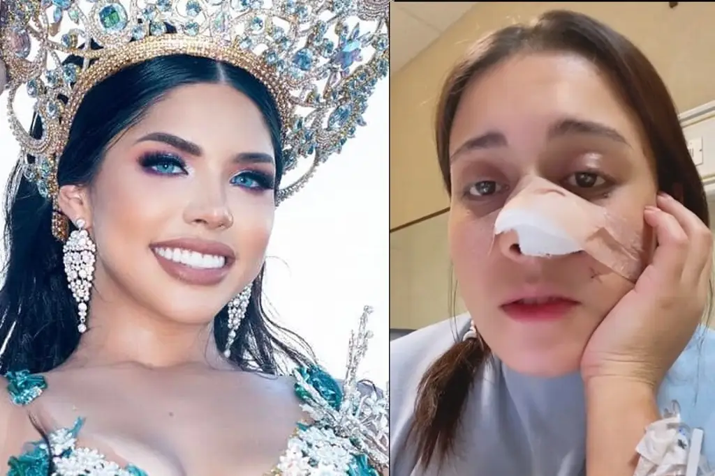 Imagen Yeri MUA regalará cirugía estética a joven que le arrancaron la nariz de una mordida 