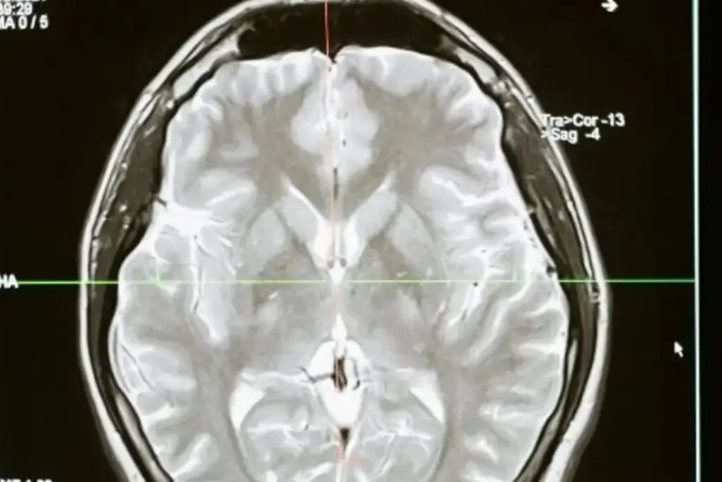 Imagen  ¿Qué es un ataque cerebrovascular y cómo evitarlo? 