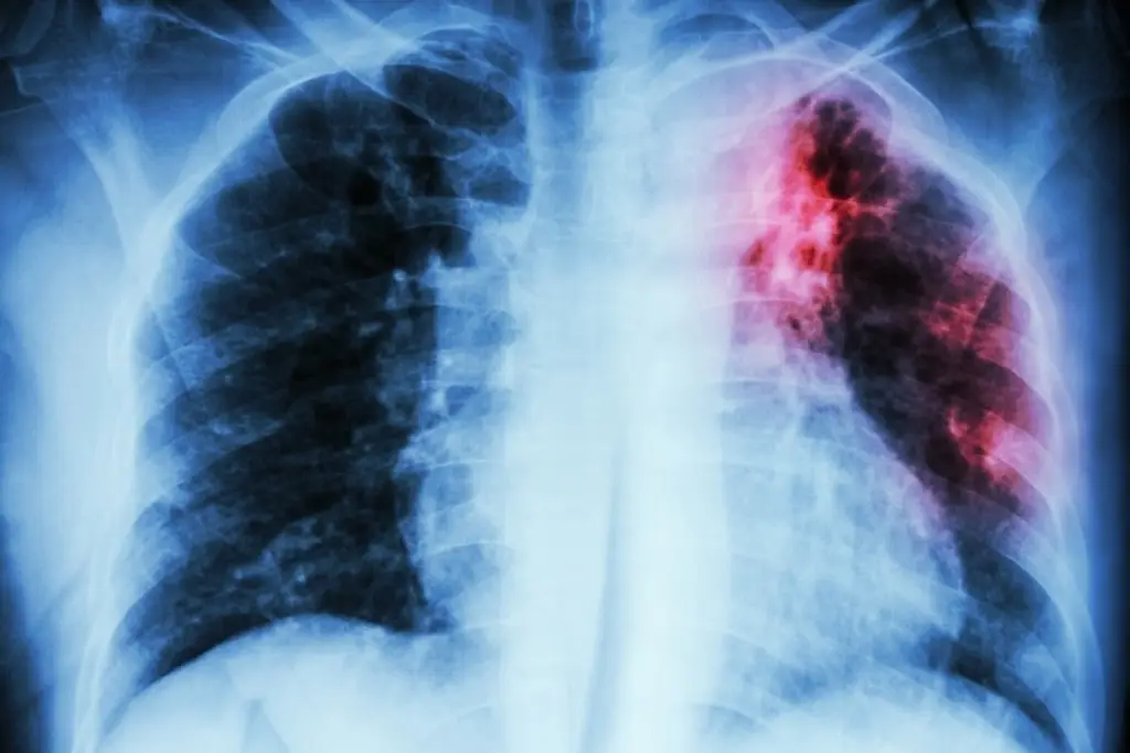 Imagen En Veracruz reprochan falta de atención a personas con VIH y tuberculosis