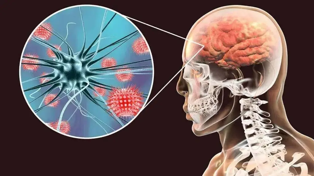 Imagen ¿Qué es la meningitis y cómo se produce?