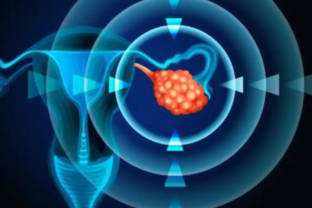 Imagen ¿Qué es el cáncer de ovario y cómo detectarlo?