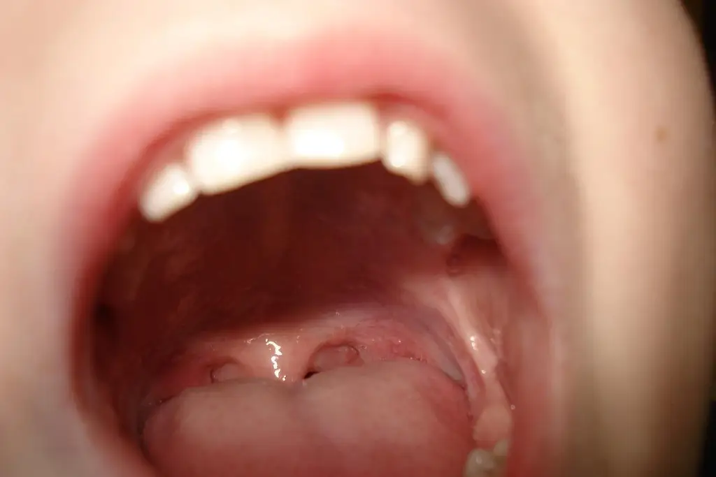 Imagen ¿Sabías que una lesión en la lengua podría ser cáncer bucal? 