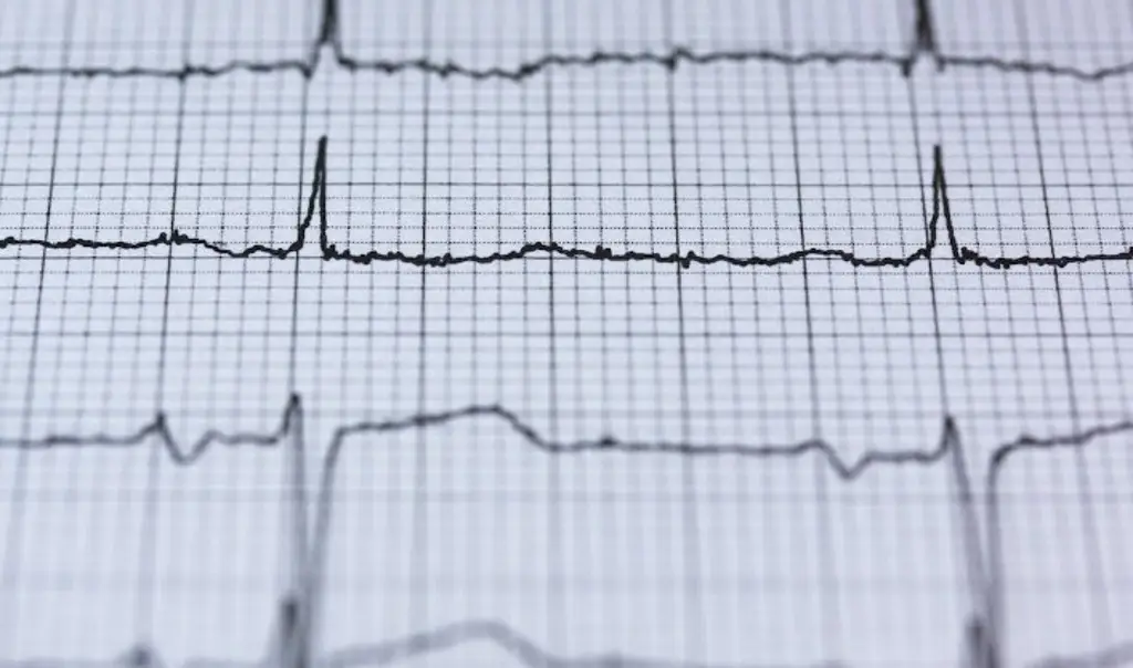 Imagen ¿Cuáles son las principales enfermedades cardiovasculares? 