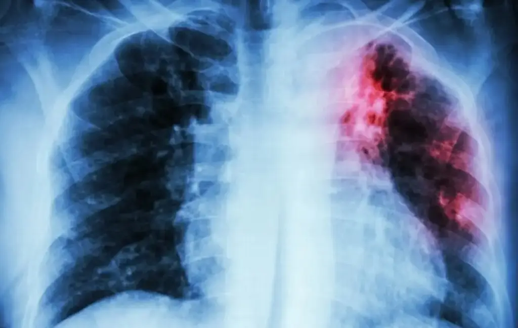 Imagen ¿Qué es la tuberculosis y cuáles son sus síntomas? 