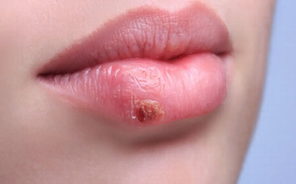 Imagen ¿Qué es el herpes y cuáles son sus síntomas? 