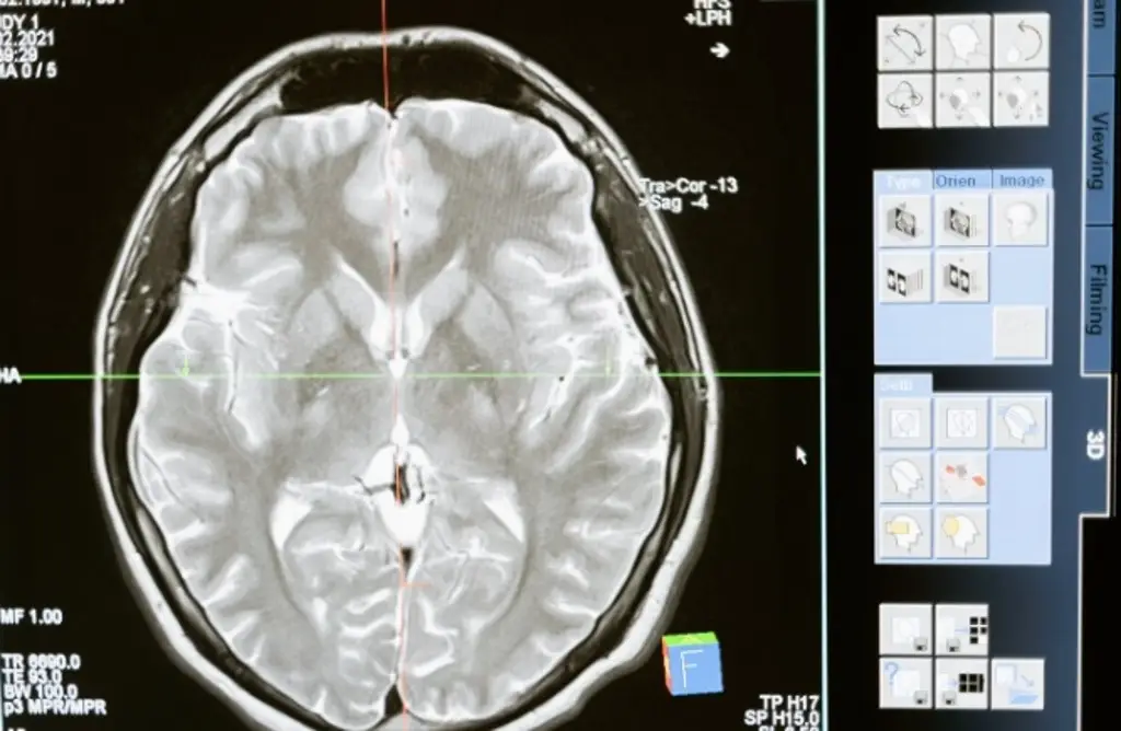 Imagen Implante cerebral puede mejorar funciones cognitivas tras una lesión traumática, según estudio
