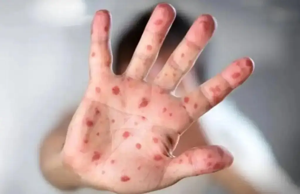 Imagen Suben a 9 los casos de sarampión en Florida