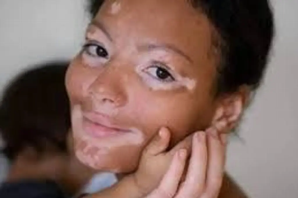 Imagen Hoy 25 de junio es el Día Mundial del Vitiligo ¿Por qué se celebra?